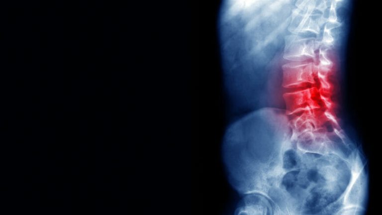AI Model Predicts Response to Spinal Cord Stimulation for Chronic Pain