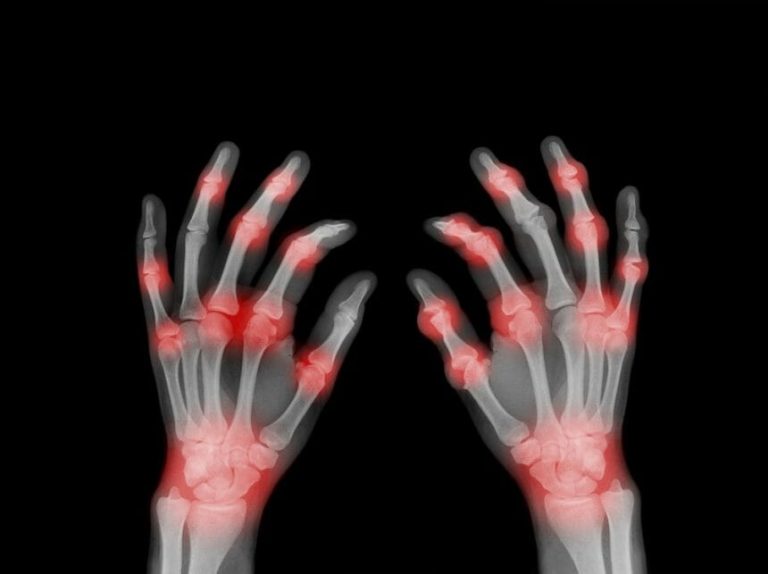 Fatty Tissue Transfer Improves Finger Osteoarthritis Symptoms